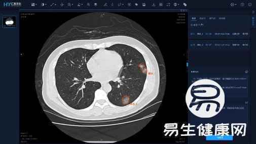 非常时期“筛查+确诊”两不误，华为云联合汇医慧影用影像AI提升检测效率