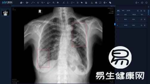 非常时期“筛查+确诊”两不误，华为云联合汇医慧影用影像AI提升检测效率