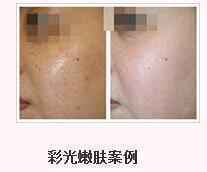做彩光嫩肤 拥有白皙光滑的肌肤