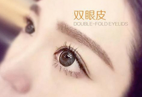 北京美诗沁双眼皮价格 割双眼皮贵不贵