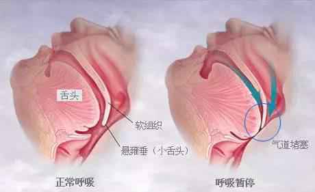 人为什么会打呼噜 打呼噜就是睡得香吗？