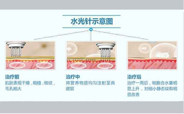 打完水光特别肿怎么办呢