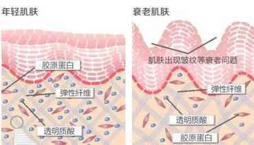 爱贝芙除皱的植入材料安全吗