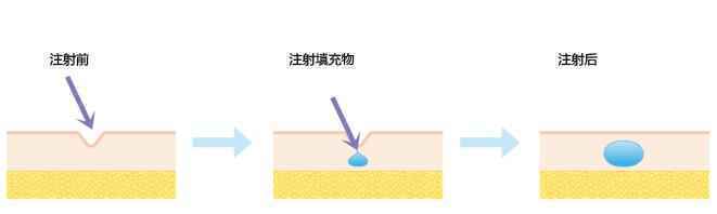 爱贝芙除皱的植入材料安全吗