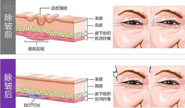 额部除皱可以用除皱针吗