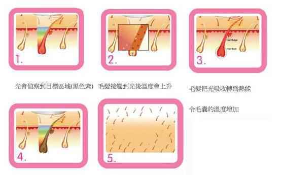 激光脱腋毛可以除狐臭吗