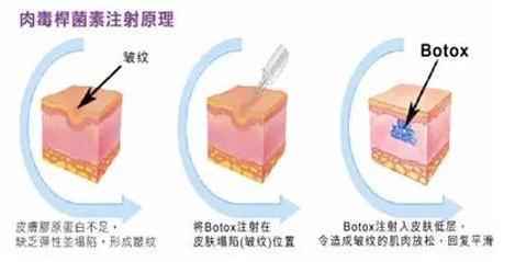 肉毒素注射除皱疗效显著吗