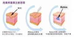 肉毒素除皱术后能热敷吗