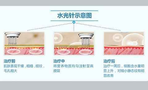 粗汉子也一样清丽脱俗--水光针