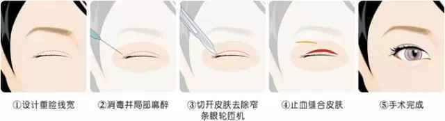 割双眼皮方法那么多，哪一个才是合适你的？