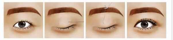 割双眼皮方法那么多，哪一个才是合适你的？