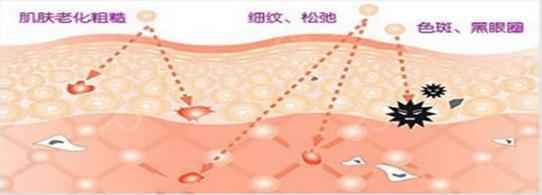 光子嫩肤适不适用于痘痘肌呢