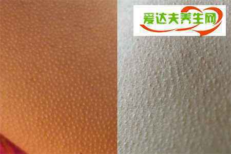 鸡皮疙瘩皮肤怎么治