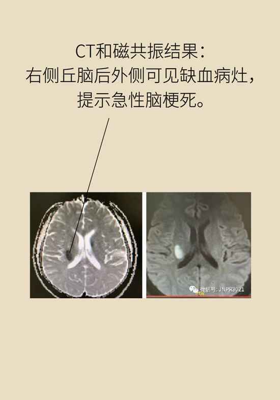 27岁男子卒中偏瘫，只因犯了3个不可挽回的错误