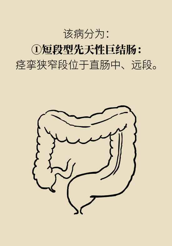 宝宝用开塞露还便秘，警惕先天性巨结肠