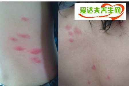 螨虫性皮炎
