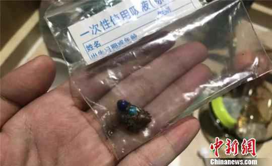 从患者体内取出的磁力珠，其中有3颗已经被肠液腐蚀发黑 浙江大学明州医院供图