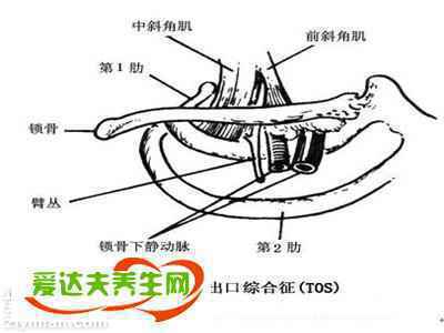 胸廓出口综合征