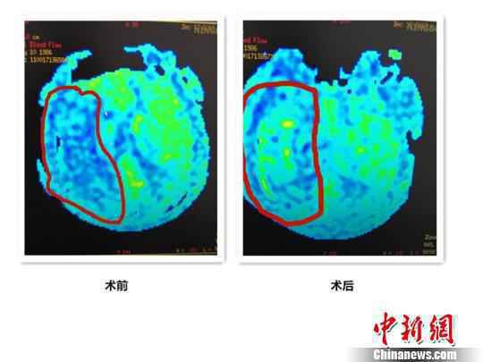 吃外卖、熬夜、少运动 宁波32岁白领突发脑梗死