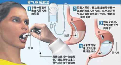 新减肥法不必动手术 吞“气球”让食欲大减(图)