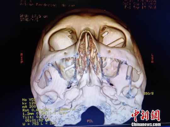 图为陈兴的CT。重庆市急救中心供图