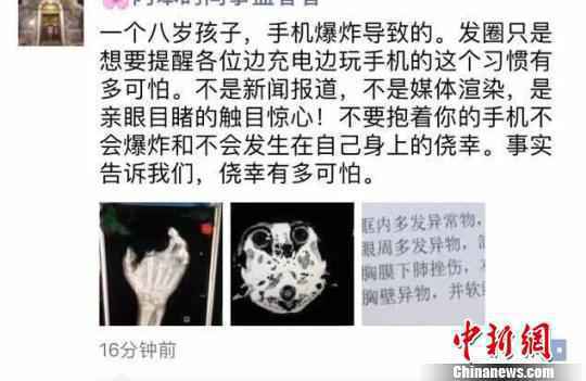 一张手机爆炸八岁小孩手掌被炸烂的朋友圈截图在微信群疯传，警示大家不要边充电边玩手机。网络图片