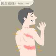 重组带状疱疹疫苗接种为什么50岁以上的人优先