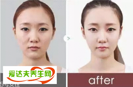 眼袋怎么恢复