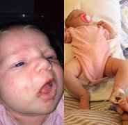 英母亲警告亲吻新生儿或使其患上致命唇疱疹
