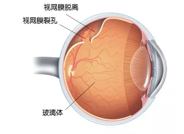 视网膜脱落示意图