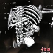 完整胚胎寄生腹内 男婴接受“剖腹产”手术